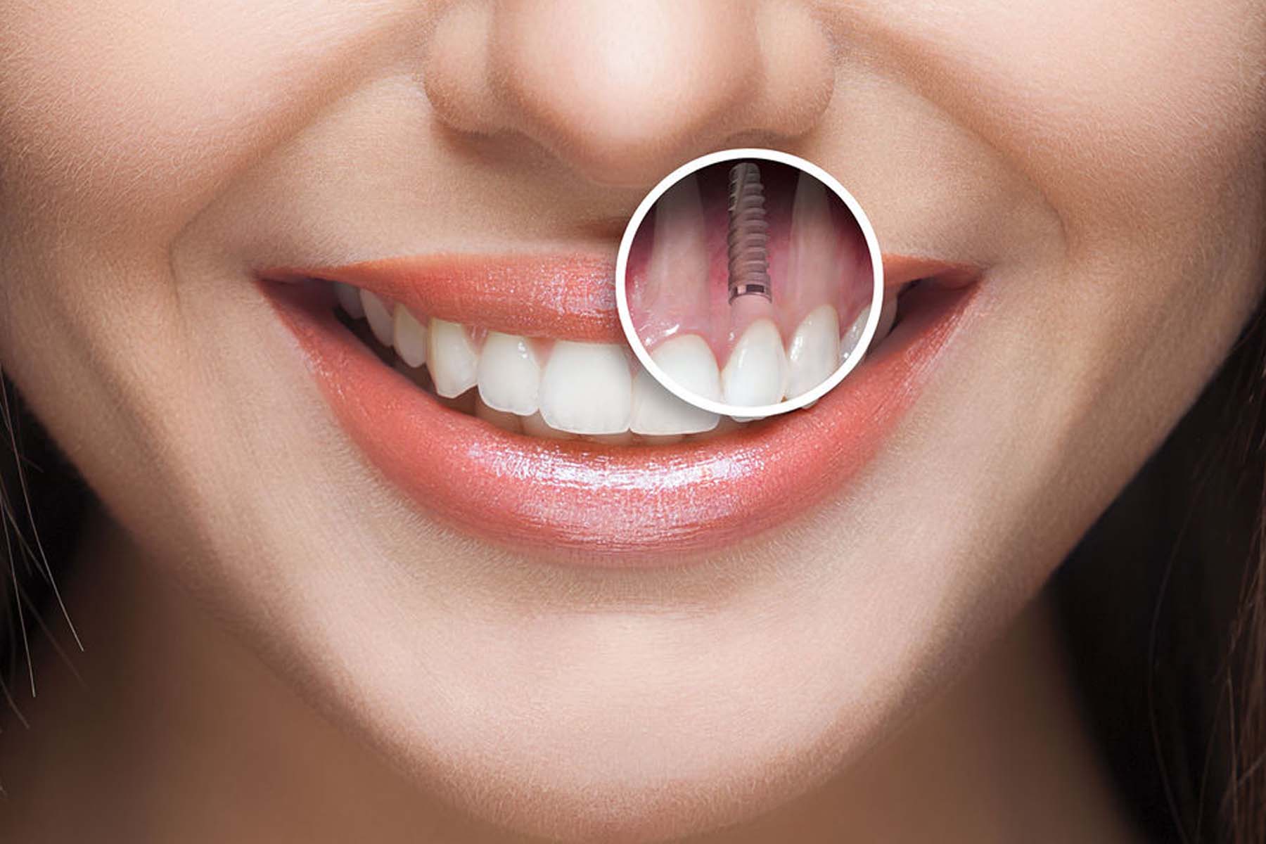 dentalimplants