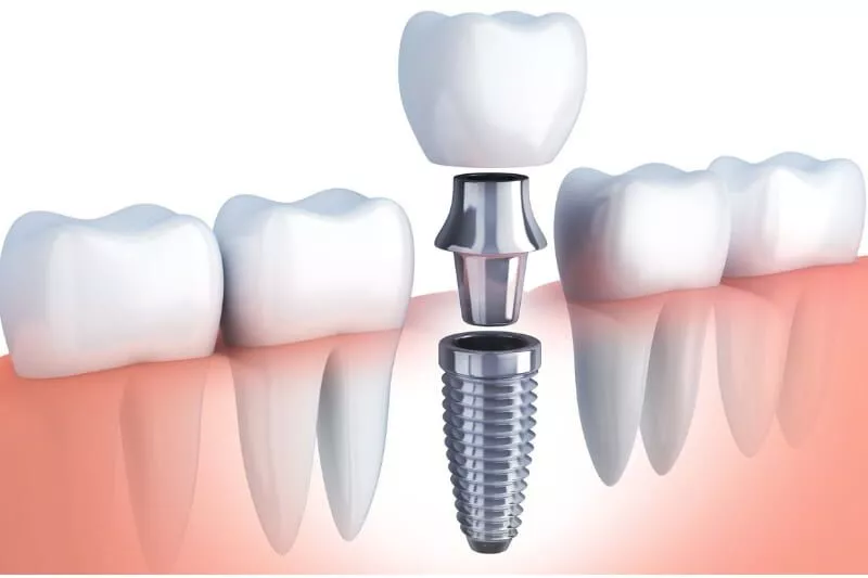 odontikoimplant